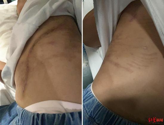 ▲小小左侧胸腹部有一条长达24厘米的疤痕(左),周边还有多处狗抓伤印