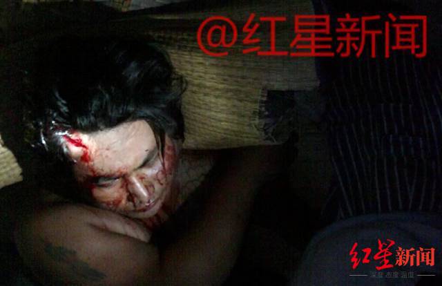 ▲案发后,去诊所包扎伤口的张海宾